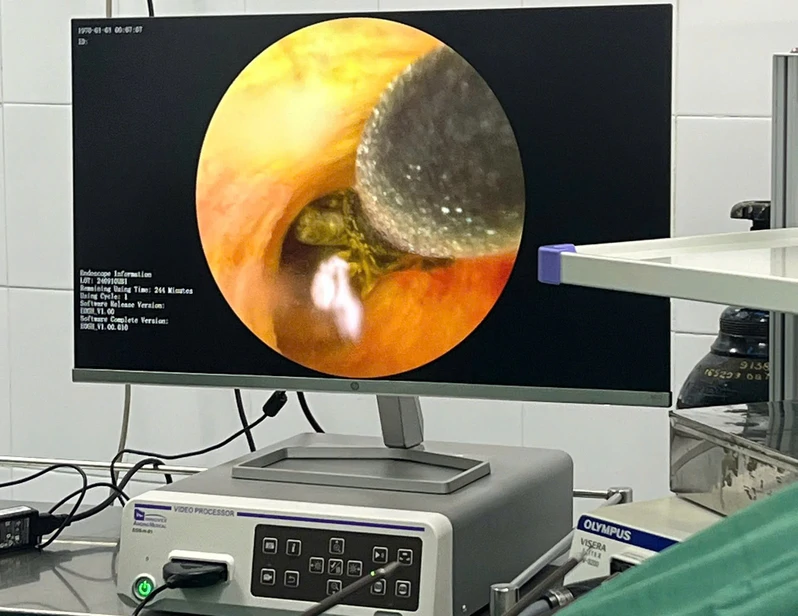 Bệnh viện Quân dân y miền Đông: Phẫu thuật thành công nội soi mở ống mật chủ lấy sỏi dưới hướng dẫn của ống soi mềm