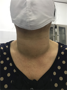 Bệnh viện Quân dân y miền Đông mổ thành công bệnh nhân bị phình tuyến giáp đa hạt 2 thùy