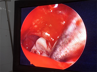 Bệnh viện Quân dân y miền Đông phẫu thuật thành công ca bệnh viêm xoang do nấm