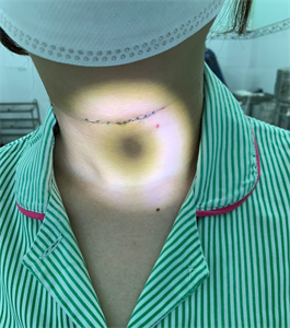 Bệnh viện Quân dân y miền Đông phẫu thuật thành công bệnh nhân bị nang giáp móng