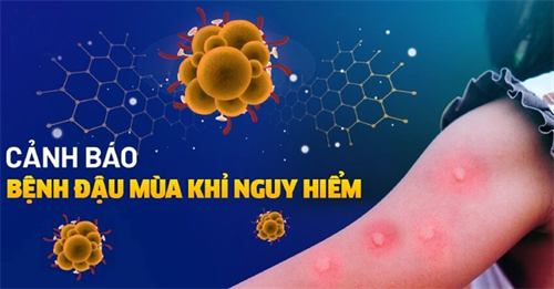 Làm thế nào để bảo vệ bản thân khỏi nguy cơ mắc bệnh đậu mùa khỉ?