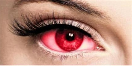Bệnh đau mắt đỏ