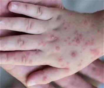 Không nên quá hoang mang về bệnh đậu mùa khỉ