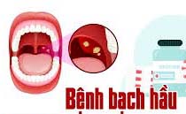 Biến chứng và cách phòng bệnh bạch hầu